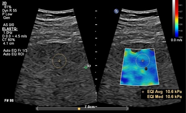 필립스 EPIQ Elite_Auto ElastQ